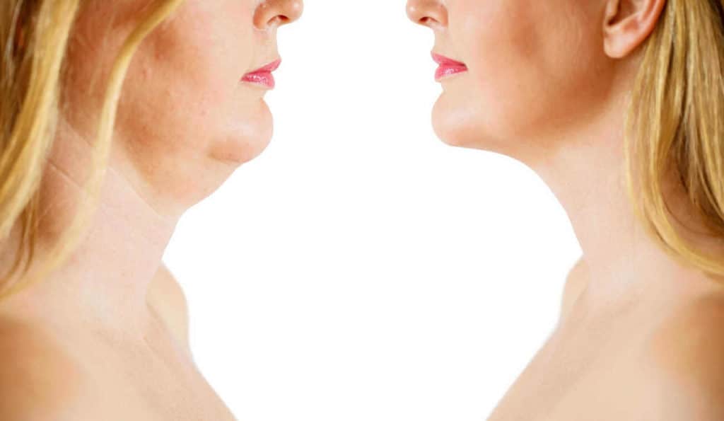 Double Chin treatment Greater London (Hounslow) before and after results