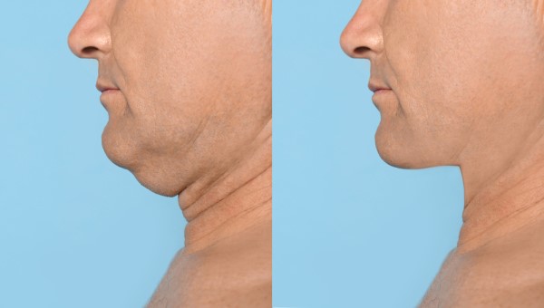 Which Non-Surgical Treatments Work Best for Jowls and Loose Skin Greater London (Hounslow)?