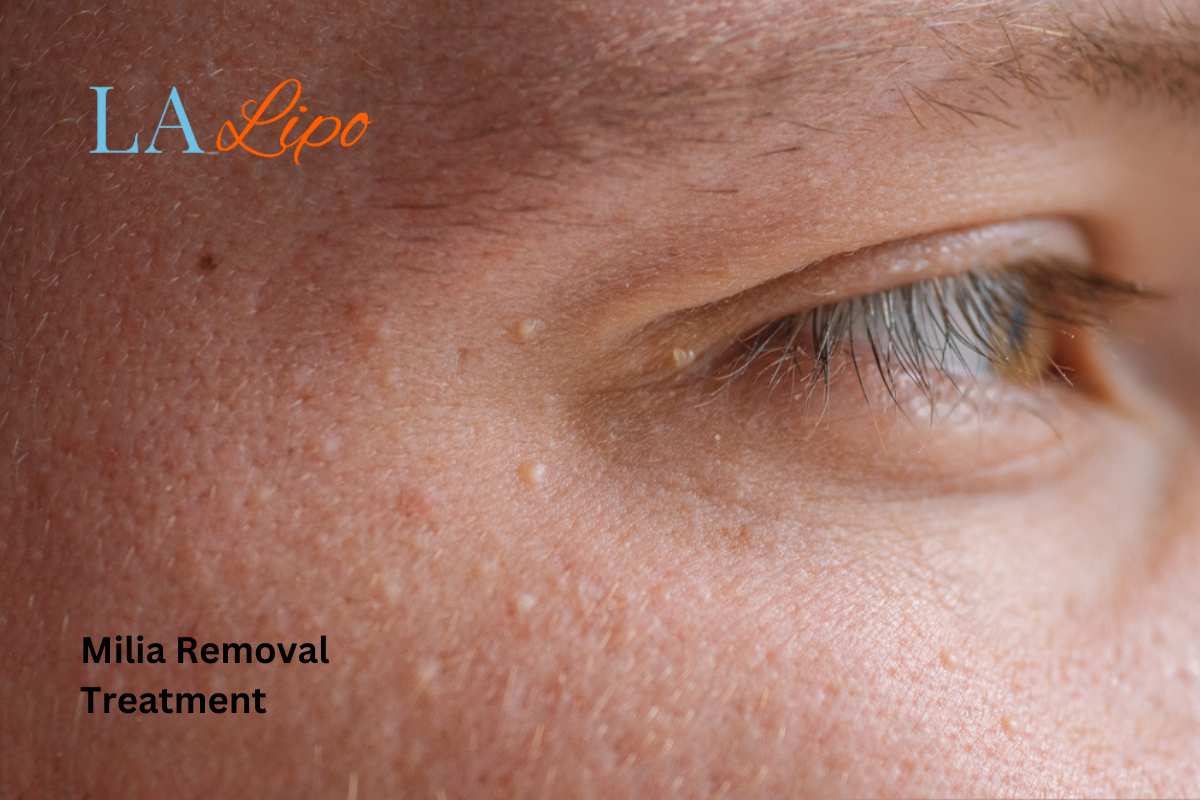 Cryopen Milia Removal: Is It the Easiest and Safest Option Greater London (Hounslow)?