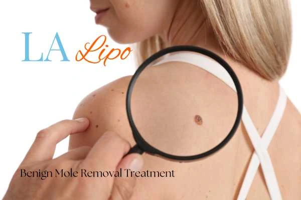 Woman having her inspection of blemish before mole removal Greater London (Hounslow)