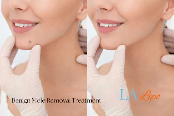 woman's before and after mole removal Greater London (Hounslow) results