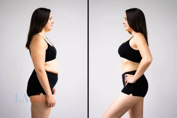image of woman before and after results of LA-EMS Body Sculpting Greater London (Hounslow) to help treat Diastasis recti