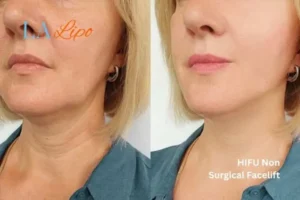hi-fu for wrinkles Greater London (Hounslow) before and after results