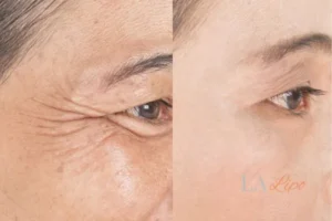 Before and after results of woman - HI-fu wrinkles reduction treatment Greater London (Hounslow)