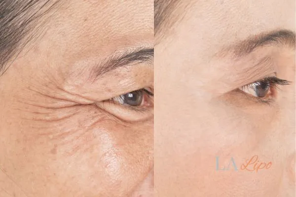 Before and after results of woman - HI-fu wrinkles reduction treatment Greater London (Hounslow)