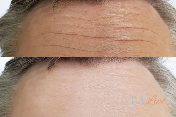 results of HIFU Greater London (Hounslow) on mans forehead to help reduce lines and wrinkles