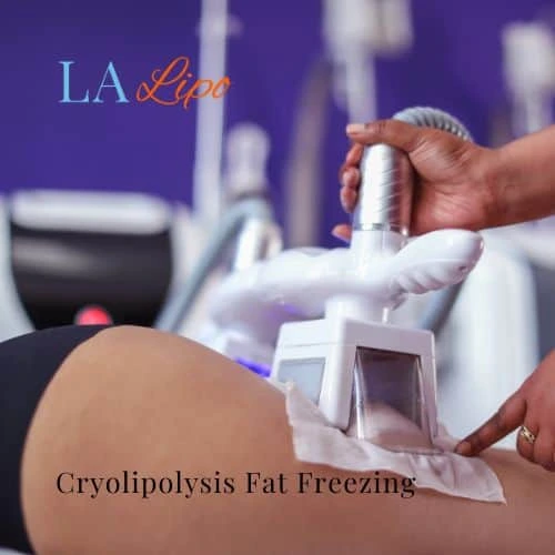 fat freezing - Cryolipolysis Greater London (Hounslow)