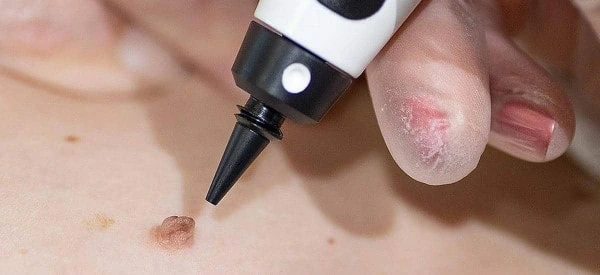 skin tag removal using cryopen Greater London (Hounslow)