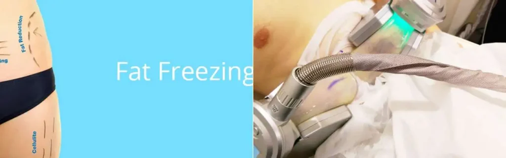 Fat freezing Greater London (Hounslow) on multiple areas of the body
