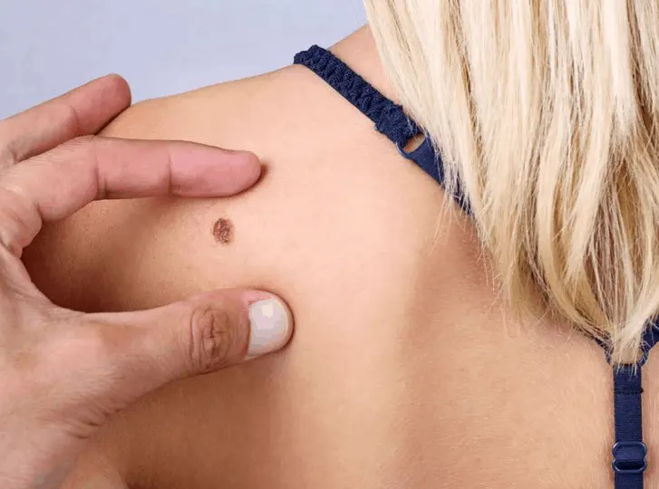 woman having mole removal Greater London (Hounslow) consultation before treatment.