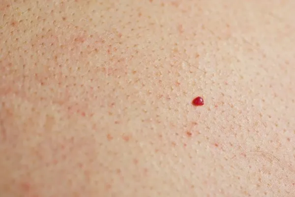 close up of a cherry angioma Greater London (Hounslow)