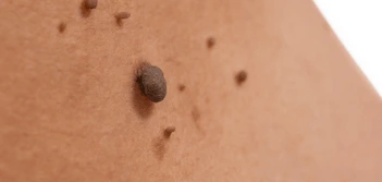 image of a skin tag Greater London (Hounslow)