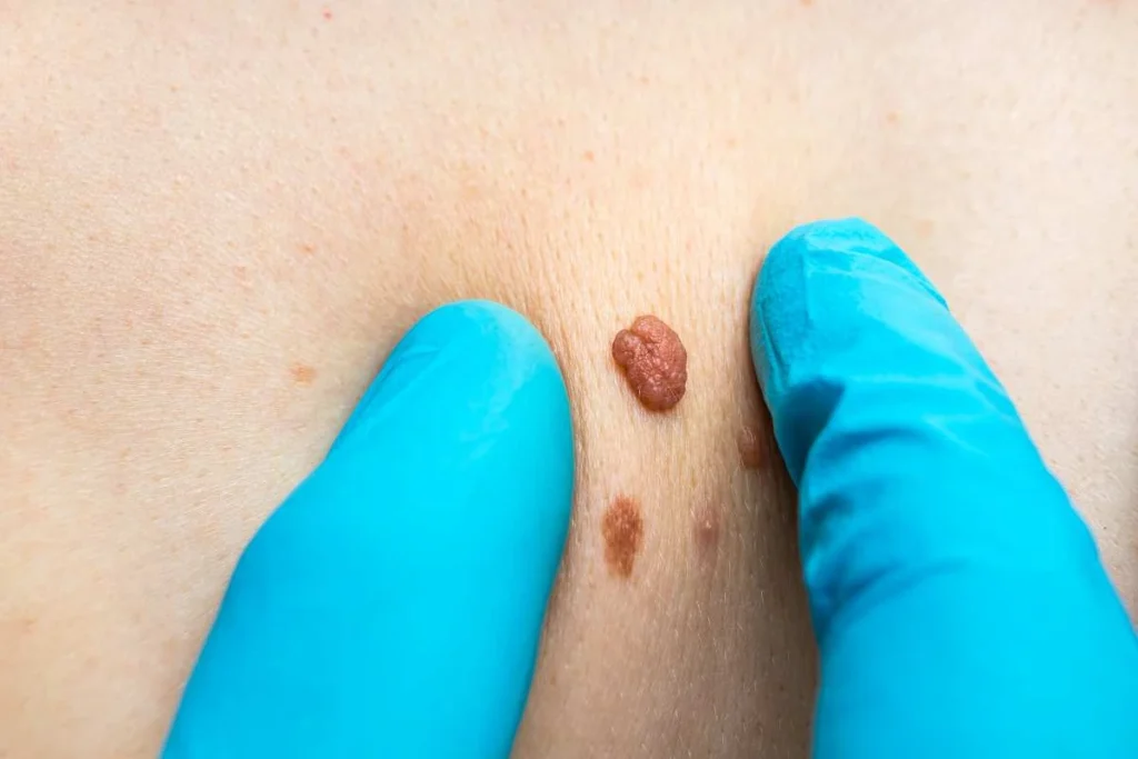 Consultant examining a skin tag Greater London (Hounslow)