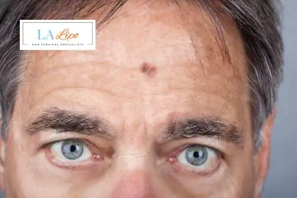 Solar Lentigo Removal Greater London (Hounslow) image of man with mark on his forehead