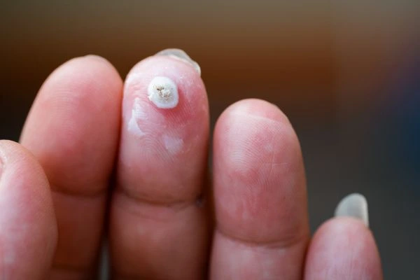 wart on person finger - cryotherapy to treat from LA LIPO Greater London (Hounslow)