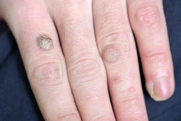 photo of warts on person hand - see wart removal Greater London (Hounslow) from LA LIPO