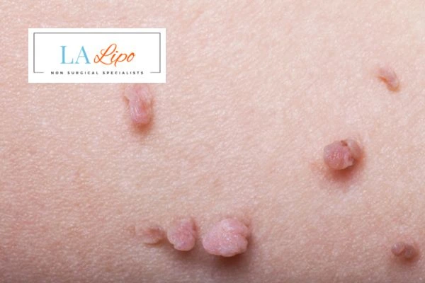 Does cryopen skin tag removal Greater London (Hounslow) hurt? Find out now call our team today!