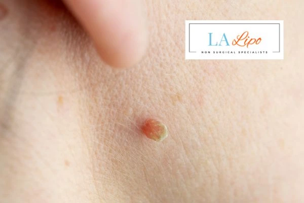 Book skin tag removal Greater London (Hounslow) today speak to our team now!