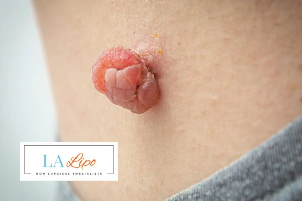 Interested in skin tag removal Greater London (Hounslow)? Concerned about the pain? Find out more today!