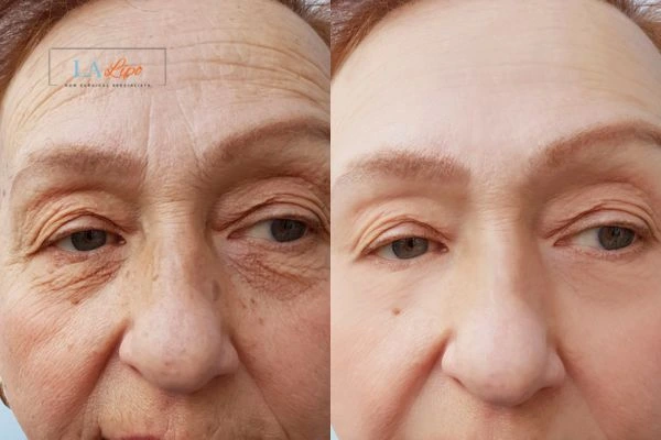 The powerful benefits of Morpheus8 Treatment Greater London (Hounslow) - Call Our team today!