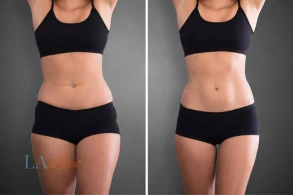 before and after results of non-surgical treatment to help a woman's body image and mental health Greater London (Hounslow)