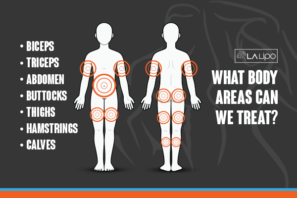 Diagram to show areas you can have LA-EMS Body Sculpting Treatment Greater London (Hounslow)