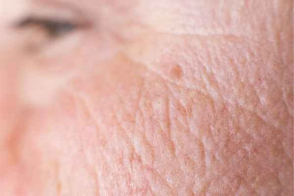 close up picture of a woman's face showing an age spot Greater London (Hounslow)