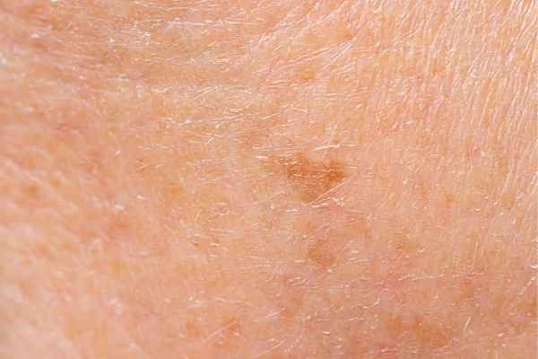 close up picture of age spots Greater London (Hounslow)