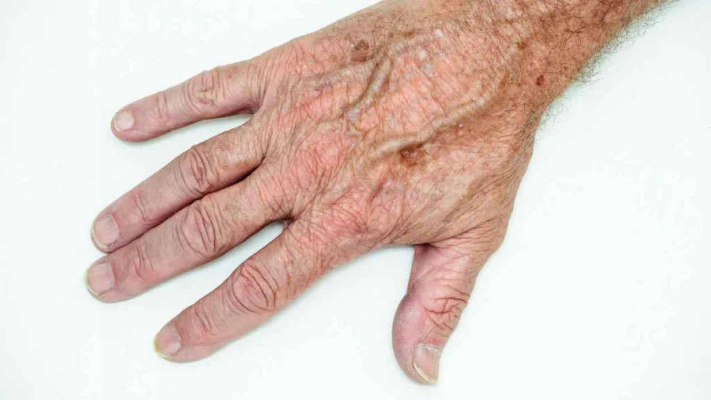 Male hand showing age spot Greater London (Hounslow)