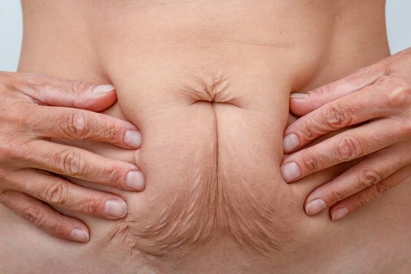 Image of a woman's stomach with loose skin - example of skin tightening Greater London (Hounslow) options